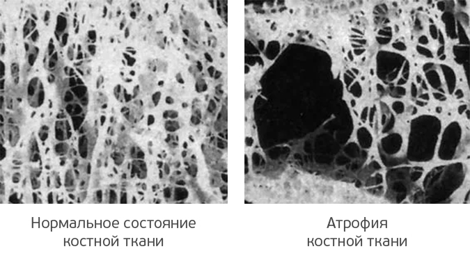 Атрофия костной ткани под микроскопом